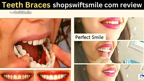 swift smile teeth brace
